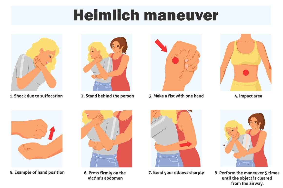 Maniobra de Heimlich (hasta 5 compresiones)