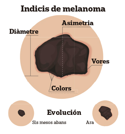 Indicis de melanoma