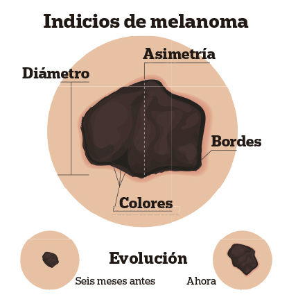 Indicios de melanoma