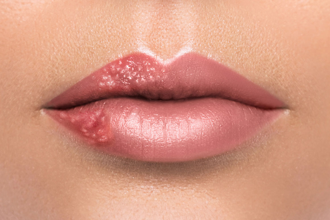 Recurrences of photo-induced cold sores can be prevented in 90% of patients
