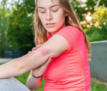 After a bee sting, the first step is to check whether the stinger remains lodged in the skin and remove it carefully as soon as possible, without pressing the venom sac.