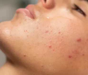 In general, summer acne tends to disappear on its own and does not require treatment. 