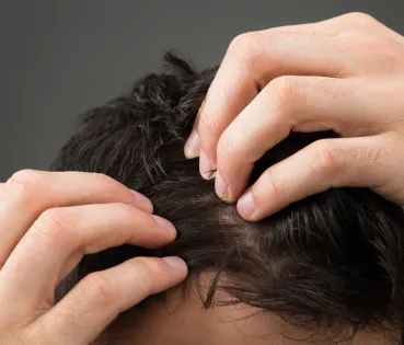 When hair shedding is seasonal and not associated with an underlying condition, its effects can often be minimised. 