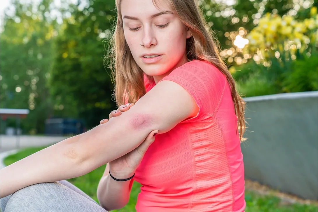 After a bee sting, the first step is to check whether the stinger remains lodged in the skin and remove it carefully as soon as possible, without pressing the venom sac.